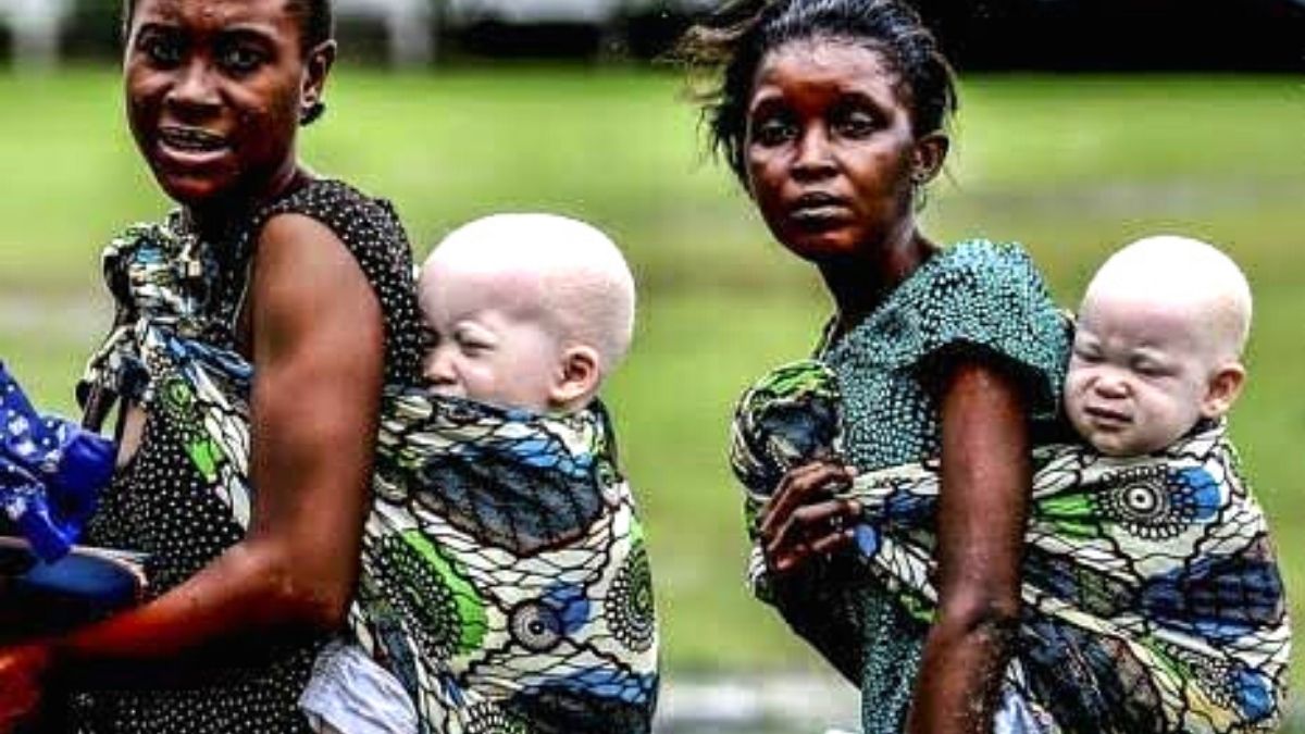 World Albinism Day: Osinbajo Calls for a Reverse of Negative Mindsets on Those Living With Albinism